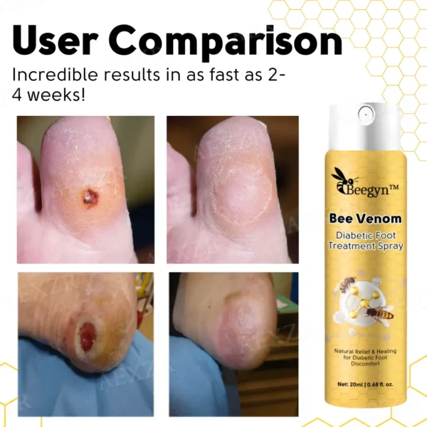 Beegyn™ Bee Venom Diabetic Foot Treatment Spray