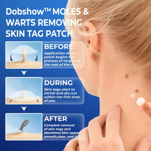 Dobshow™ Moles & Warts Removing Skin Tag Patch