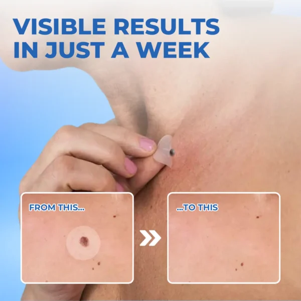 Dobshow™ Moles & Warts Removing Skin Tag Patch