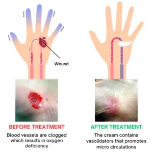 Glucomend™ Diabetic Wounds Treatment Cream