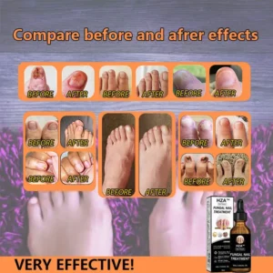 HZA™Fungal Nail Treatment