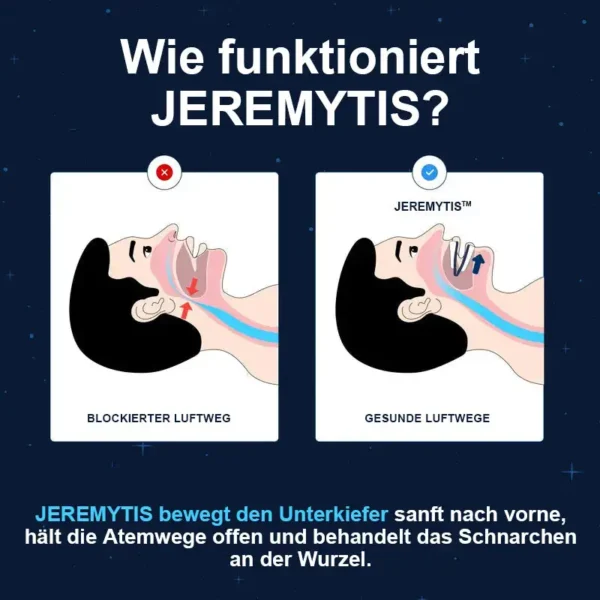 [Offizieller Markenladen] JEREMYTIS™ Verstellbares Anti-Schnarch-Mundstück