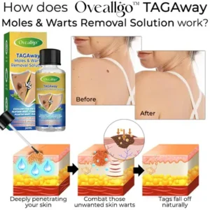 Oveallgo™ TAGAway Moles & Warts Removal Solution